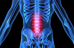 Osteohondroza ledvene hrbtenice