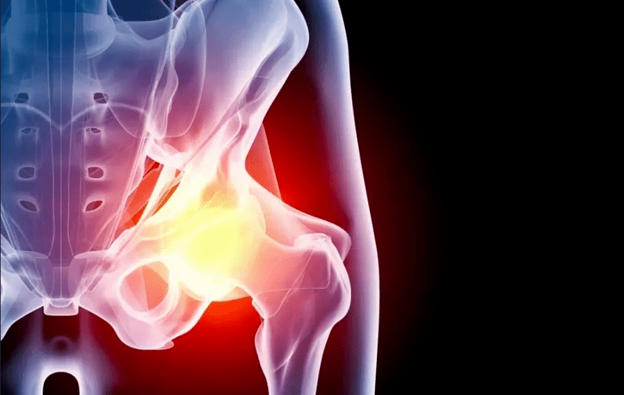 Artroza kolčnega sklepa