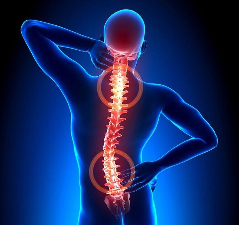 osteohondroza hrbtenice kot vzrok za bolečine v hrbtu