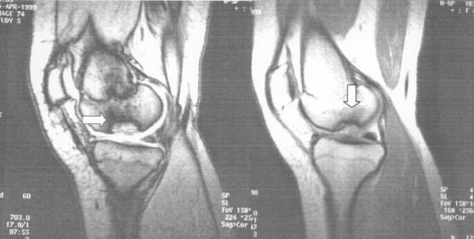 rentgenska slika osteohondroze dissecans v kolenskem sklepu
