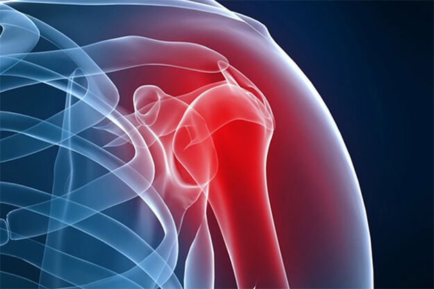 bolečine v ramenih zaradi osteoartritisa