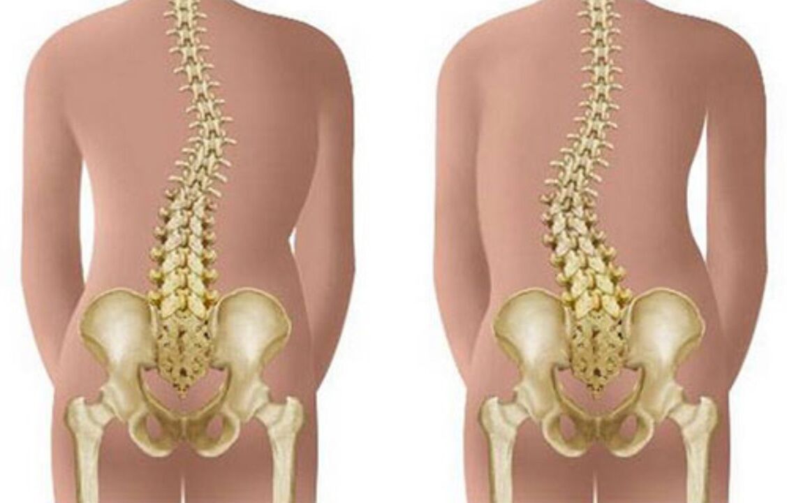 skolioza kot vzrok bolečine v hrbtu v predelu lopatic