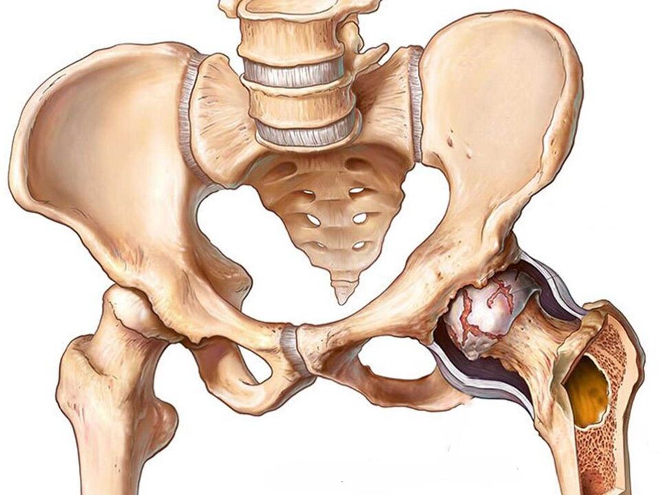 artroza kolčnega sklepa