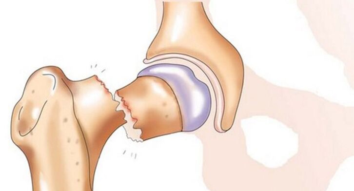 Zlom vratu stegnenice spremljajo hude bolečine v kolčnem sklepu