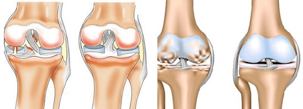 Artritis in arthroza